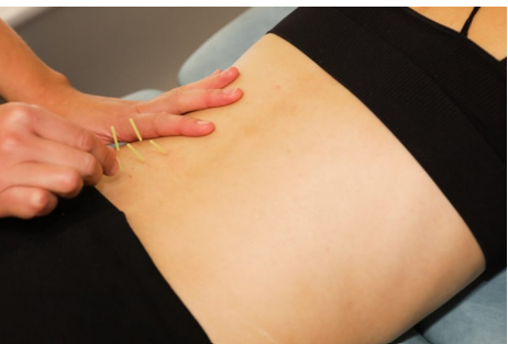 Acupuncture treatment